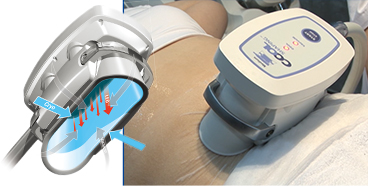 脂肪冷却|ルビーパレス｜ルビー館 RUBY-PALACE｜（サウナ・アカスリ24